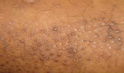 Heat Rash Treatment with Skiinprot